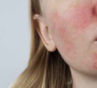 Rosacea