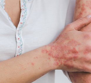 Psoriase