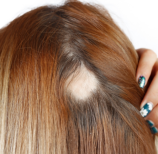 Alopecia