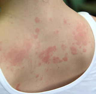 Outras condicoes inflamatorias