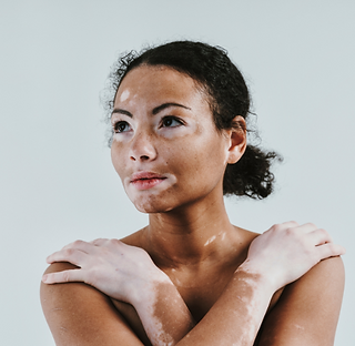 Vitiligo